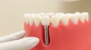 Имплантация зубов: что это, как проходит и почему это действительно работает